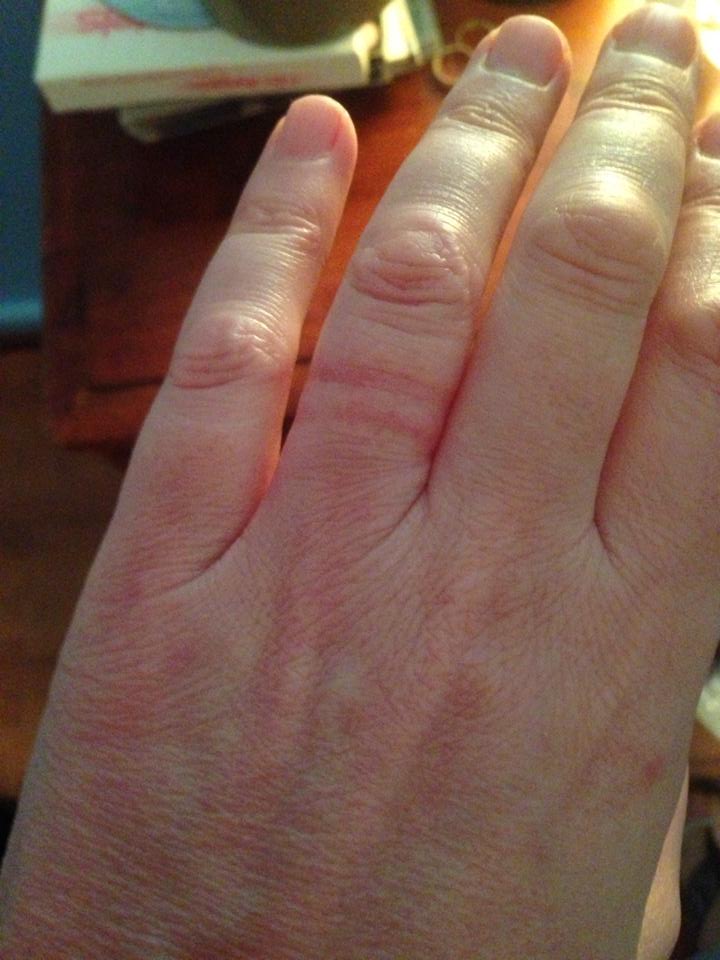 Wedding ring rash after pregnancy